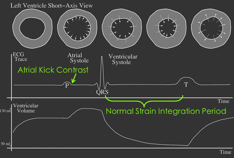 Atrial Kick Induced Strain Timing Diagram